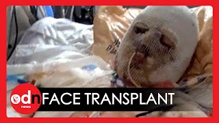 Worlds First Face and Hand Transplant Surgery Hailed a Success [upl. by Christensen]