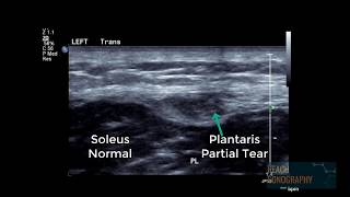 Normal and abnormal plantaris tendon of the calf [upl. by Cyrilla641]