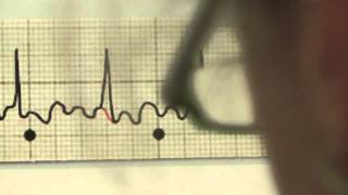 EKG für Pflege Teil 20  Vorhofflattern interpretieren [upl. by Ettenim]