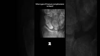 Avascular necrosis example Scaphoid 48 Trauma Xray Fracture complications radiologychannel007 [upl. by Nosinned107]