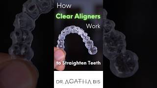 How Clear Aligners work to straighten teeth without braces clearaligner clearaligners [upl. by Art]