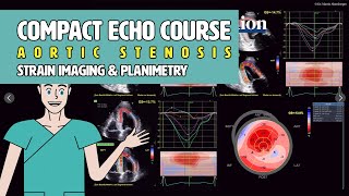 〖Echocardiography〗 Strain imaging amp Planimetry in aortic stenosis ❣️ [upl. by Ahel]