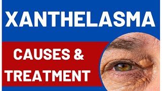 Xanthelasma Meaning Causes And Treatment [upl. by Isaiah721]