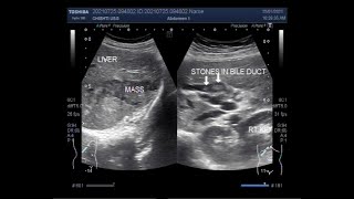 Distended Gallbladder with Cholelithiasis associated with Choledocholithiasis and Hepatic Mass [upl. by Garrik]