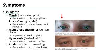 Horners Syndrome LO4  M1 Anatomy Learning Objectives [upl. by Eirek]