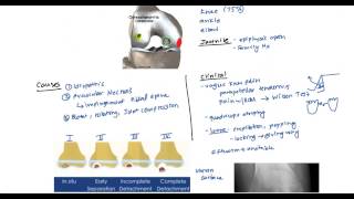 Osteochondritis and Osgood Schlatter for the USMLE [upl. by Natsyrk]