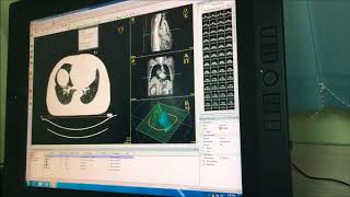 Radiotherapy Treatment Planning Breast Cancer [upl. by Odlaner]