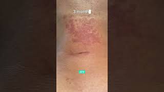 LIPOMA REMOVAL 3 MONTHS POSTOP RESULTS  DR TANVEER JANJUA NEW JERSEY [upl. by Ralat]