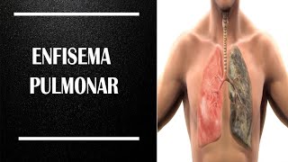 Enfisema Pulmonar Enfermagem Educacional [upl. by Goodwin]