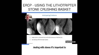 ERCP  Using the Lithotripter Stone Crushing Basket [upl. by Doownel]