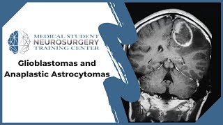 Glioblastomas and Anaplastic Astrocytomas [upl. by Augy512]