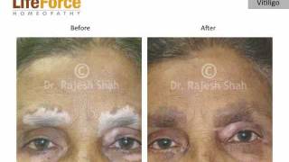 Leucoderma Before amp After Treatment Photos of Patients Cured at Life Force [upl. by Meijer]