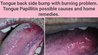 Tongue back side bump with burning problemTongue Papillitis possible causes Diagnosisamphome remedies [upl. by Tarryn]