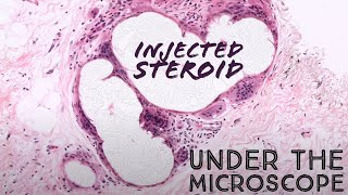 Steroid injection under the microscope kenalog with giant cell reaction in hypertrophic scar short [upl. by Henrieta400]