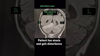 Acute brain pathology mri radiology weakness [upl. by Earesed]