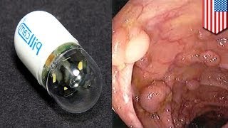 FDA approves swallowable Pillcam to detect colon cancer [upl. by Navanod]