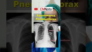 Spontaneous Pneumothorax doctor medical nursing [upl. by Ecinad]