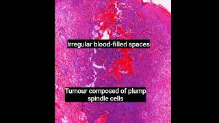 Histopathology of Aneurysmal Dermatofibroma dermpath dermatopathology pathology shorts [upl. by Silvie]