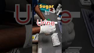 Sugar in urine viralvideo youtubeshorts medical youtube lab mbbs health urinetest clinical [upl. by Coffeng]