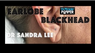 A nice earlobe blackhead extracted [upl. by Butterfield]