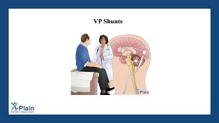 VP Shunts [upl. by Arianie]