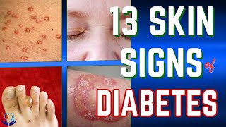 Discover 13 Skin Signs of Diabetes Now [upl. by Ojiram261]