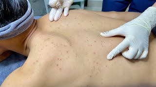 ACNE TREATMENT VU QUYNH MI Acne On Mans Back 2024 [upl. by Gessner]