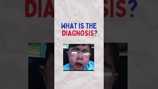 Paediatric Exam Spot Diagnosis 2 l 3 year old boy l mrcpch usmle medicalschool [upl. by Meelas]