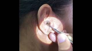 Removing Womans Giant Earwax Using An Ear Curette [upl. by Haskins]