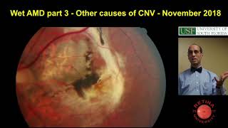 Other causes of choroidal neovascular membranes  wet AMD  Part 3 [upl. by Chaing]