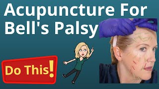 BELLS PALSY ACUPUNCTURE  know what to expect [upl. by Zeeba386]