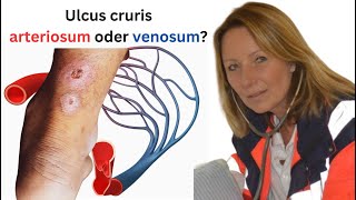 Was ist der Unterschied zwischen einem ulcus cruris arteriosum und venosum [upl. by Chem]