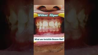 Invisible Braces be like this Clear Aligners for Teeth spacing Dr Srishti Bhatia smile braces [upl. by Bidget]