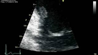 RUPTURE CHORDAE POSTEROMEDIAL PAPILARY MUSCLE  MR PROLAPSE [upl. by Vowel651]