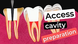 Access cavity preparation  How to prevent errors [upl. by Moshell]