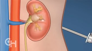 Percutaneous Nephrolithotomy PCNL for Kidney Stones in Children [upl. by Kala903]