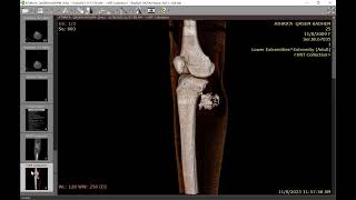 Complicated osteochondroma [upl. by Hassi]