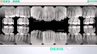 DEXIS – Introducing the allnew DEXIS Platinum Sensor [upl. by Cathey]