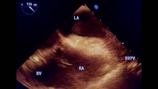 Lung tumor invading left atrium to drahmadmirdamadisiF2BFosOT1z42MaKL [upl. by Wrigley]