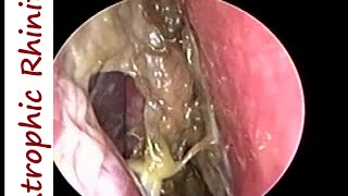 Atrophic Rhinitis Ozaena  Operated Youngs on Left amp Modified Youngs operation on Right [upl. by Macleod120]