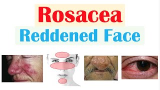 Rosacea Red Lesions on Face  Causes Triggers Types Signs amp Symptoms Diagnosis Treatment [upl. by Nessej]