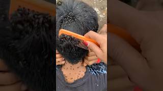 Dandruff and louse removal home remedy [upl. by Alhan802]