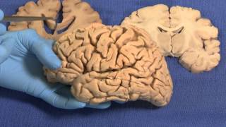 Limbic Neuroanatomy Video Lab  Brain Dissections [upl. by Harlen]