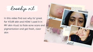 Rosehip Oil Before and After for my Hyperpigmentation and Acne Scars  10 reasons why it works [upl. by Eedeed]