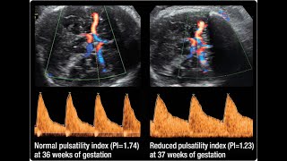 Middle Cerebral Artery Doppler  OG Capsule [upl. by Enelrahs]