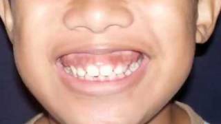 ORTHODONTIC TREATMENT  7 DEEPBITE DR DEAN A CESA [upl. by Lynnelle]