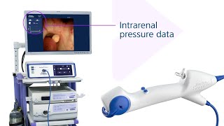 LithoVue™️ Elite SingleUse Digital Flexible Ureteroscope Animation [upl. by China132]