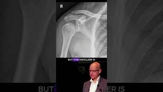 Posterior shoulder dislocation on xray [upl. by Lotty]