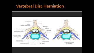 Spinal Nerves amp Vertebral Disc Herniation [upl. by Nylcoj]