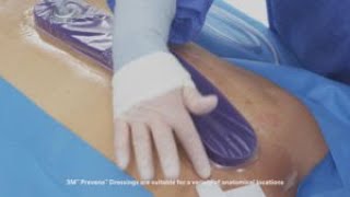 3M™ Prevena™ Therapy Tips and Tricks Video Spine [upl. by Louise]